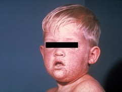 measles call